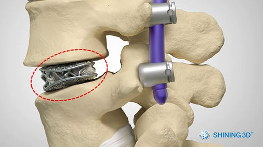 Spinal Implant Manufacturing Using EP-M250 Metal 3D Printer